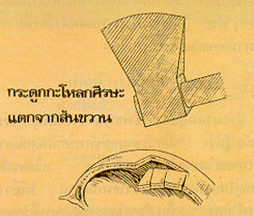 ลักษณะบาดแผลที่เกิดจากอาวุธชนิดต่างๆ